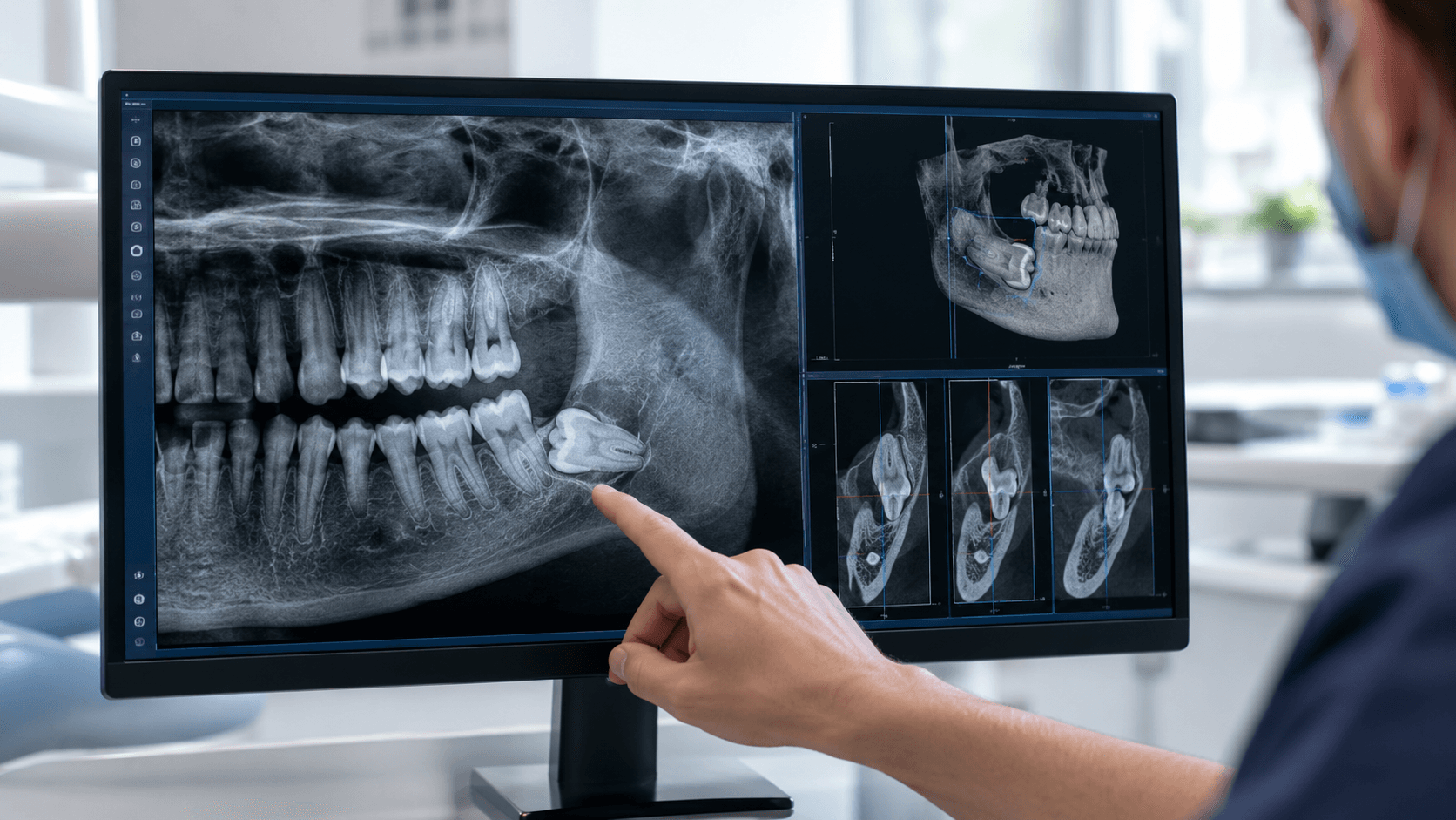 Tomografia CBCT zatrzymanej ósemki - diagnostyka przed usunięciem zębów mądrości w EBM Dentysta Poznań Piątkowo ul. Mateckiego 19