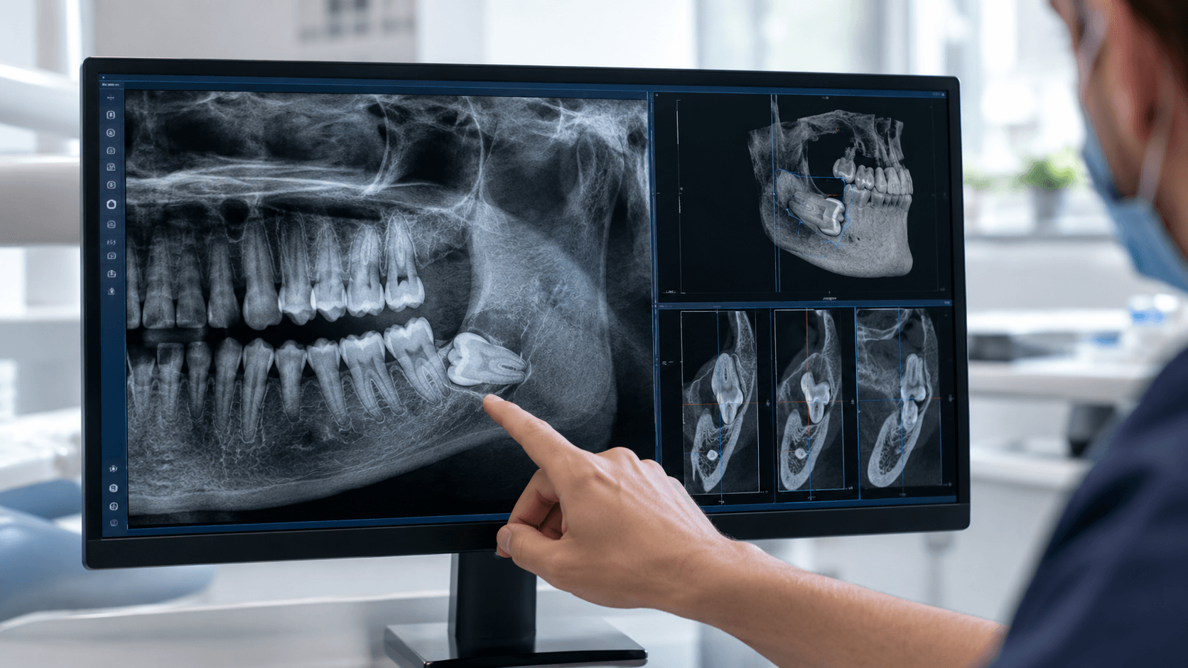Tomografia CBCT zatrzymanej ósemki - diagnostyka przed usunięciem zębów mądrości w EBM Dentysta Poznań Piątkowo ul. Mateckiego 19